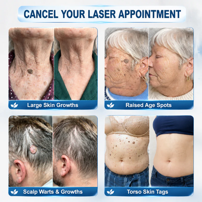 Rolimey® 7-Day Skin Tag & Blemish Remover Painless & Scar-Free – Advanced Mole & Wart Remover