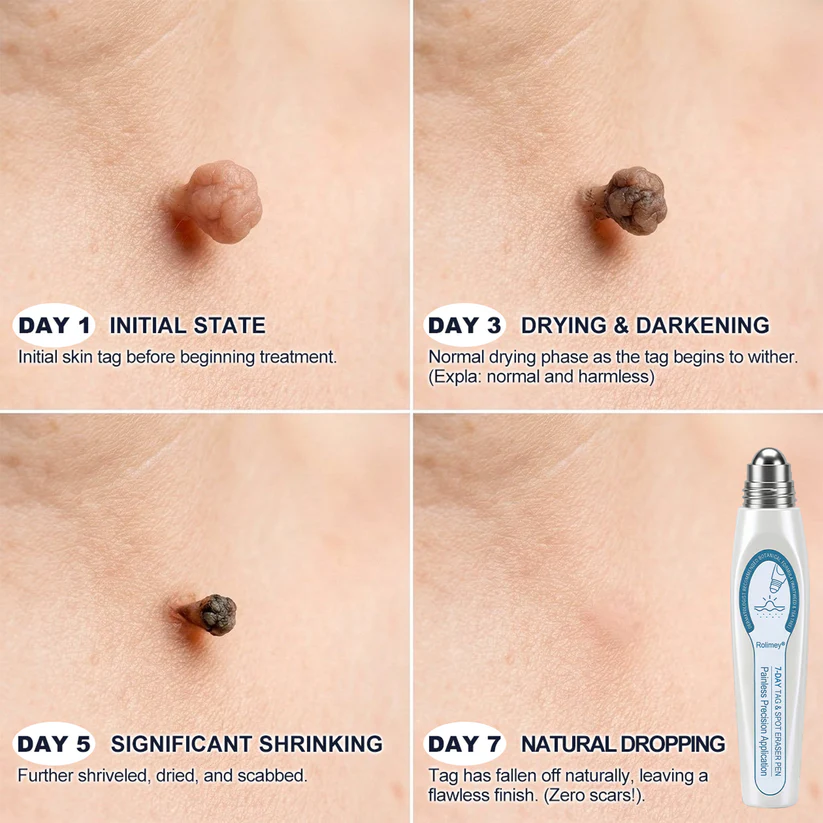 Rolimey® 7-Day Skin Tag & Blemish Remover Painless & Scar-Free – Advanced Mole & Wart Remover