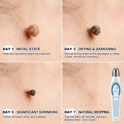 Rolimey® 7-Day Skin Tag & Blemish Remover Painless & Scar-Free – Advanced Mole & Wart Remover